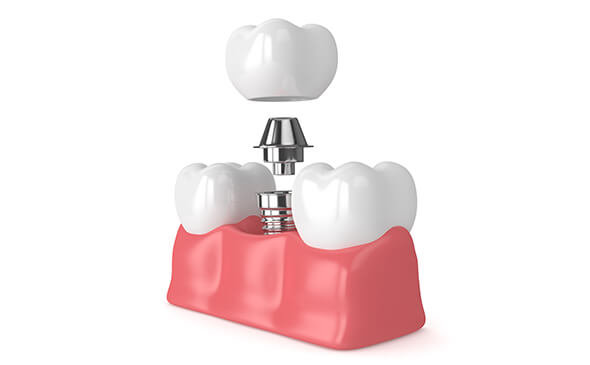 dental implants